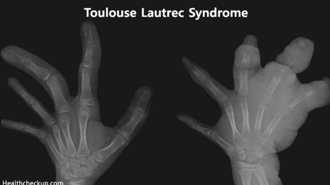 Toulouse-Lautrec Syndrome
