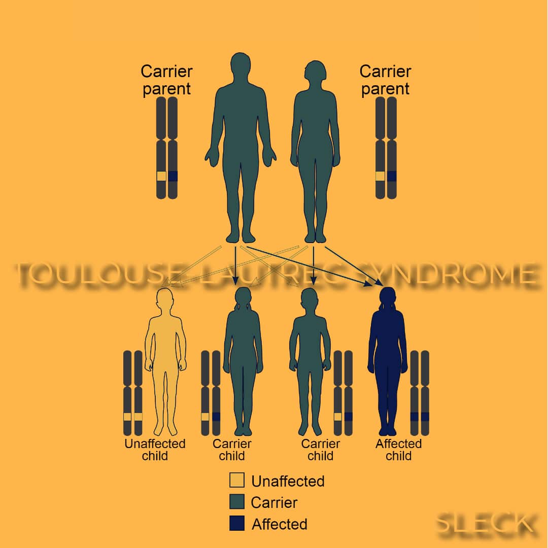 toulouse-lautrec syndrome