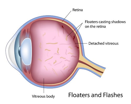 floaters after cataract surgery